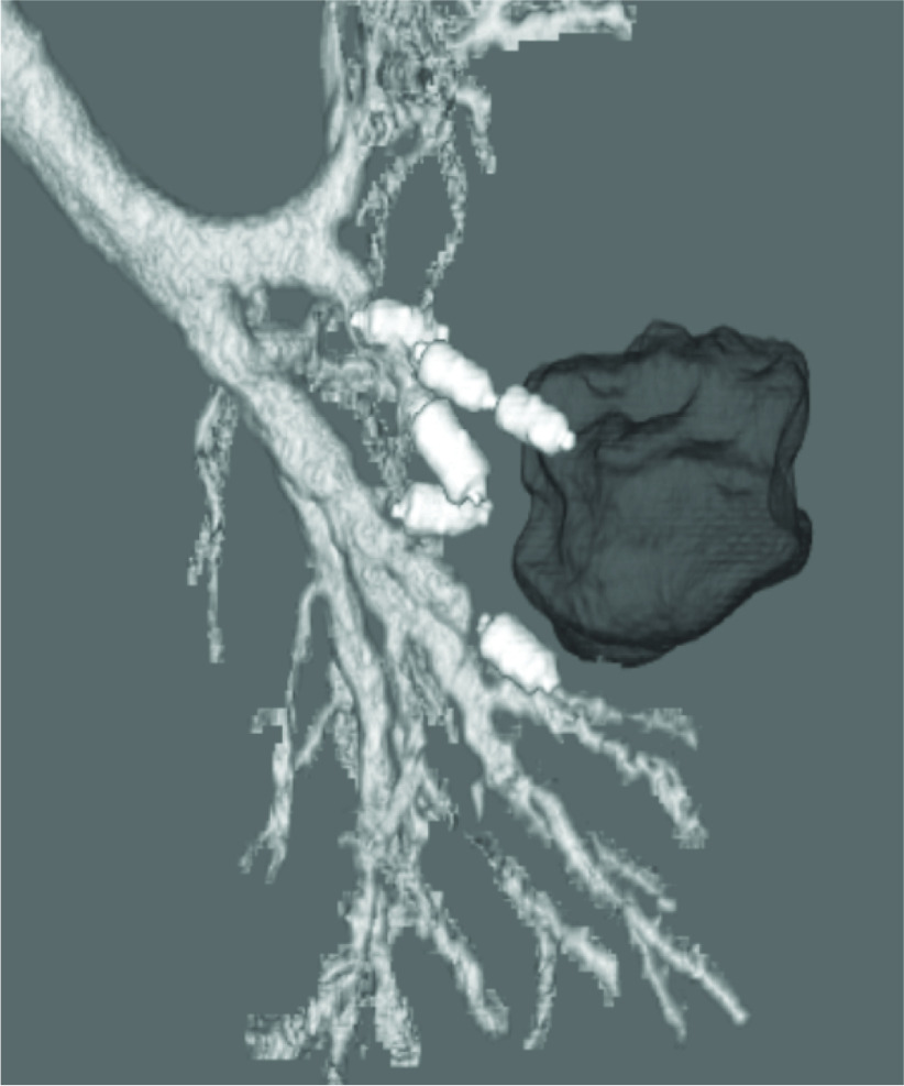 A Novel Approach to Extensive Clarithromycin-Resistant Mycobacterium avium Complex Pulmonary Disease.