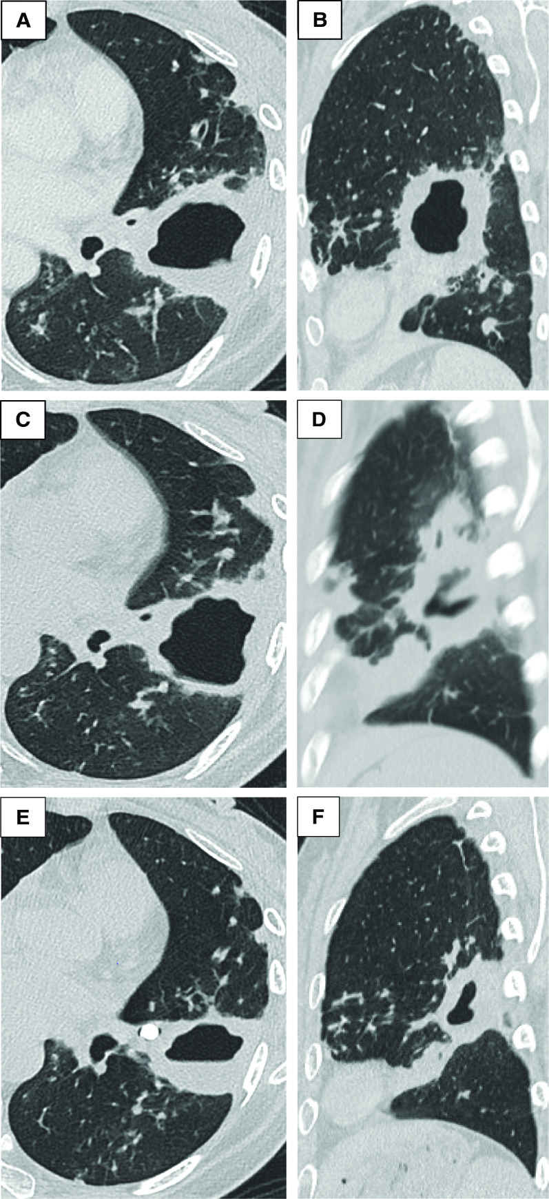 A Novel Approach to Extensive Clarithromycin-Resistant Mycobacterium avium Complex Pulmonary Disease.