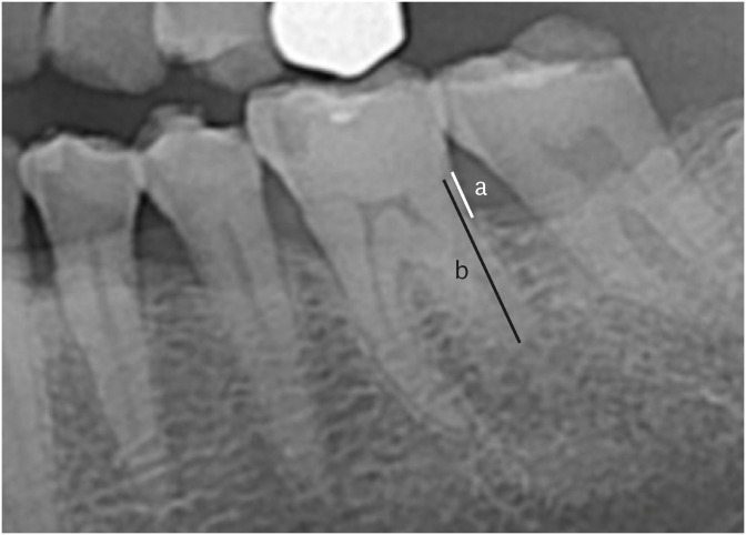 Evaluation of health screening data for factors associated with peri-implant bone loss.