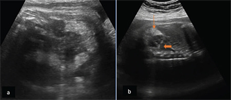 Can prenatal renal pelvicalyceal echogenic foci support the diagnosis of cystinuria?