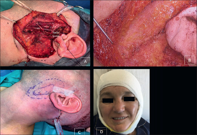 Lipofilling after total parotidectomy: a useful option to prevent functional and aesthetic sequelae.