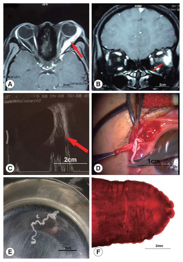 A Case of Ocular Sparganosis in China: Episode of Migration from Muscle Cone to Subconjunctiva.