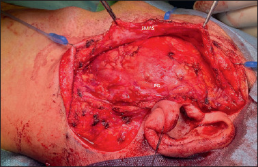 Lipofilling after total parotidectomy: a useful option to prevent functional and aesthetic sequelae.