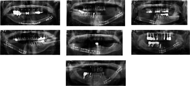 Reconstruction of mandibular defects in osteoradionecrosis and medication-related osteonecrosis of the jaw using fibula free flap and management of postoperative wound infections.