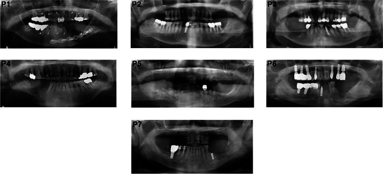 Reconstruction of mandibular defects in osteoradionecrosis and medication-related osteonecrosis of the jaw using fibula free flap and management of postoperative wound infections.