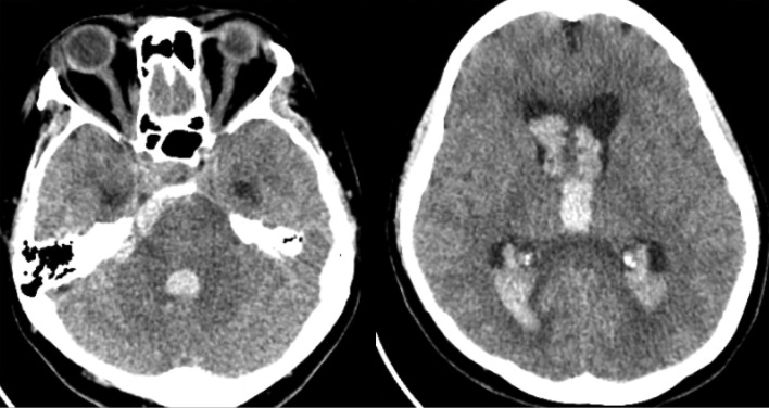 Vertebral artery dissecting aneurysm rupture under severe COVID-19