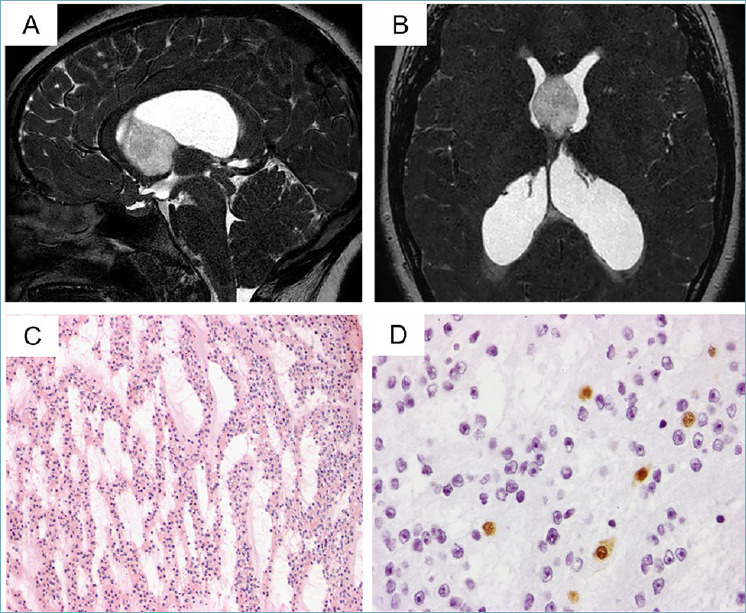 Newly recognised Tumour Types in Glioneuronal tumours according to the 5th edition of the CNS WHO Classification.