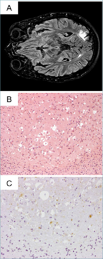 Newly recognised Tumour Types in Glioneuronal tumours according to the 5th edition of the CNS WHO Classification.