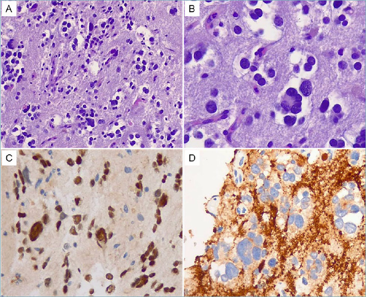 Newly recognised Tumour Types in Glioneuronal tumours according to the 5th edition of the CNS WHO Classification.