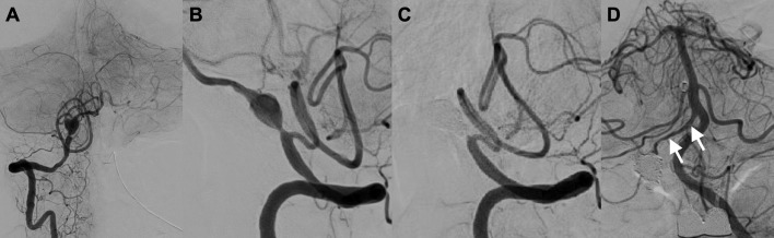 Vertebral artery dissecting aneurysm rupture under severe COVID-19