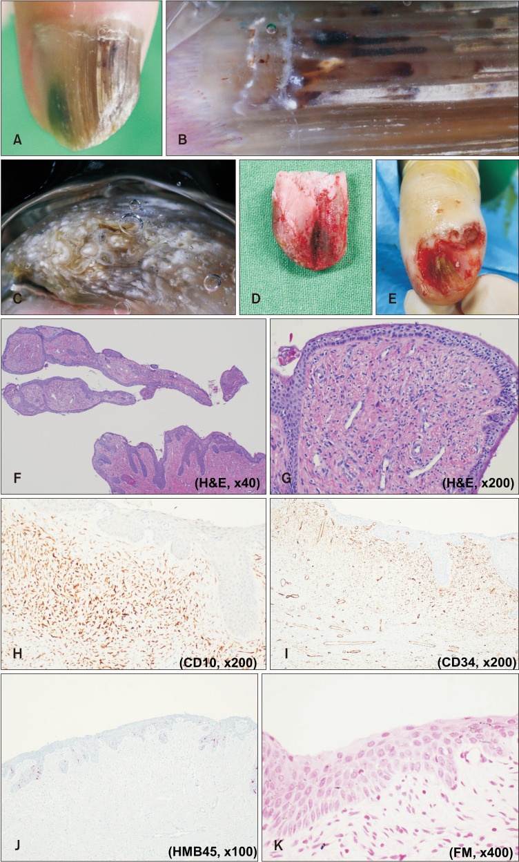 Pigmented Onychomatricoma after Trauma: A Case Report and Review of Literature.