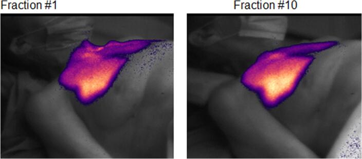 Clinical implementation of the first Cherenkov imaging system in a community-based hospital