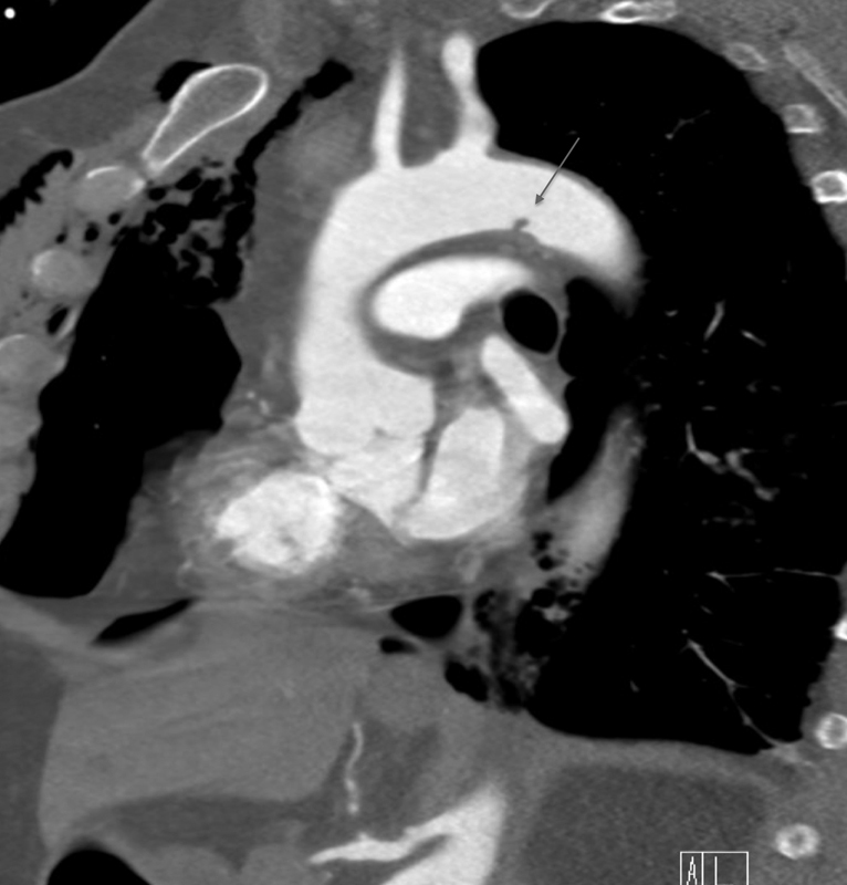 Minimal Aortic Injury Detected on Computed Tomography Angiography during Initial Trauma Imaging: Single Academic Level 1 Trauma Center Experience.