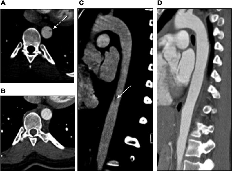 Minimal Aortic Injury Detected on Computed Tomography Angiography during Initial Trauma Imaging: Single Academic Level 1 Trauma Center Experience.