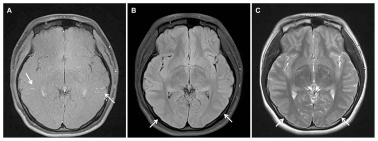 Anti-N-Methyl-D-Aspartate Receptor Encephalitis after BNT162b2 COVID-19 Vaccination.