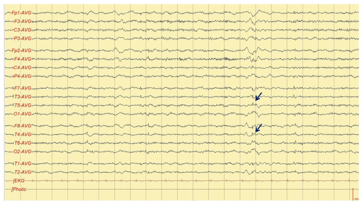 Anti-N-Methyl-D-Aspartate Receptor Encephalitis after BNT162b2 COVID-19 Vaccination.