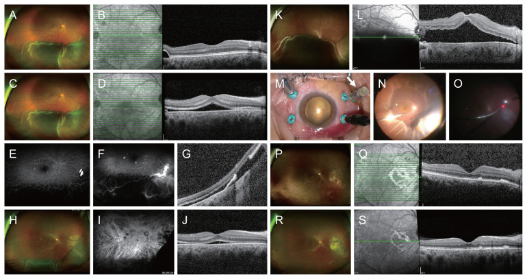 External Subretinal Fluid Drainage and Vitrectomy in Exudative Retinal Detachment Secondary to Central Serous Chorioretinopathy: A Case Report.