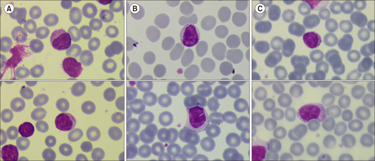 Various inclusions in chronic lymphocytic leukemia/small lymphocytic lymphoma.