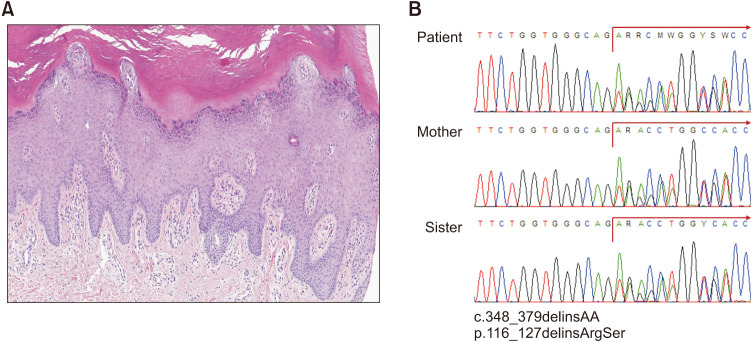 Pachyonychia Congenita with a Novel Variant in the <i>KRT16</i> Gene, c.348_379delinsAA.