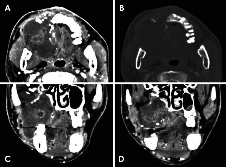 Aggressive central odontogenic fibroma in the maxilla: A case report.