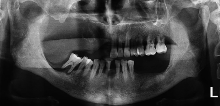 Aggressive central odontogenic fibroma in the maxilla: A case report.