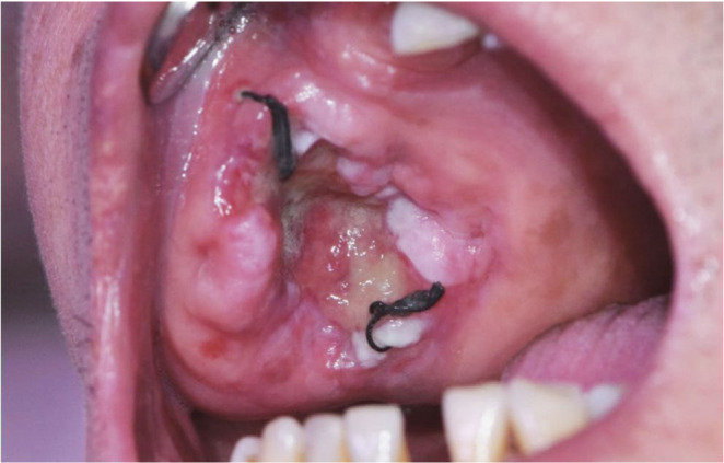 Aggressive central odontogenic fibroma in the maxilla: A case report.