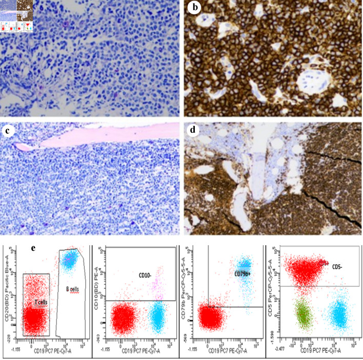 Bone Involvement as a Primary Rare Manifestation of Waldenstrom Macroglobulinemia: A Case Report and Prevalence in a Nationwide Population-Based Cohort Study.