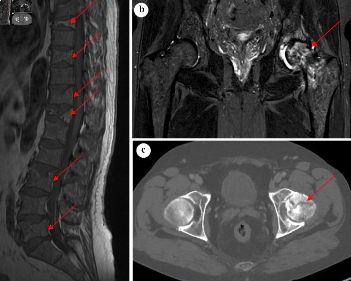 Bone Involvement as a Primary Rare Manifestation of Waldenstrom Macroglobulinemia: A Case Report and Prevalence in a Nationwide Population-Based Cohort Study.