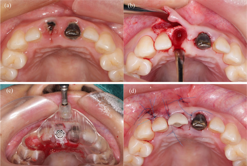 Comparison of the accuracy of immediate implant placement using static and dynamic computer-assisted implant system in the esthetic zone of the maxilla: a prospective study.