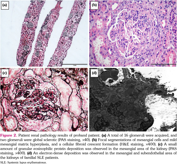 Identification of a novel mutation in complement receptor 2 in Chinese familial systemic lupus erythematosus.