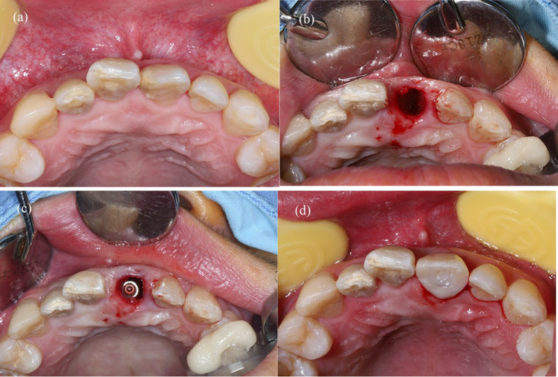 Comparison of the accuracy of immediate implant placement using static and dynamic computer-assisted implant system in the esthetic zone of the maxilla: a prospective study.