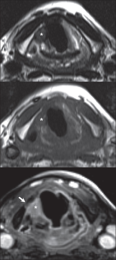 Magnetic resonance imaging to assess cartilage invasion in recurrent laryngeal carcinoma after transoral laser microsurgery.