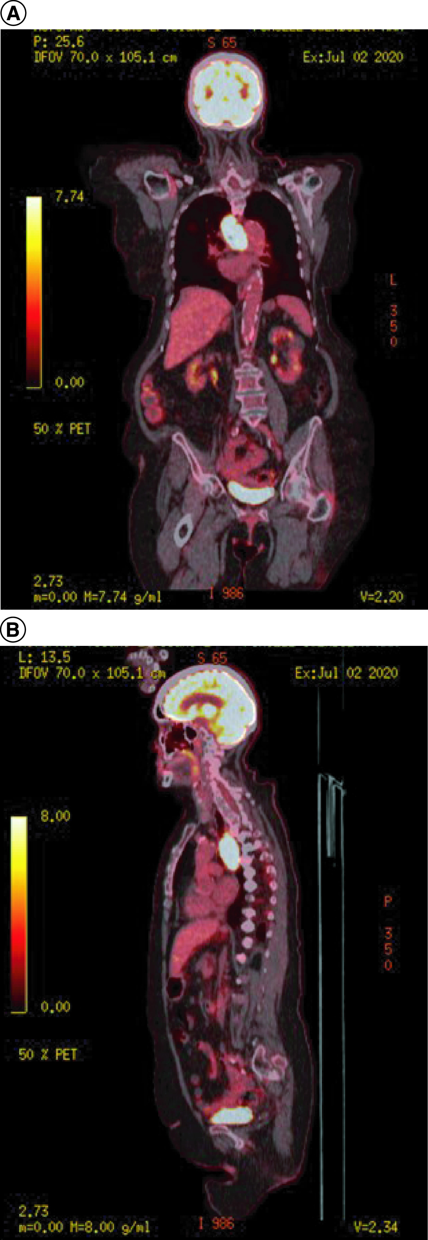 Primary esophageal melanoma: a case report.