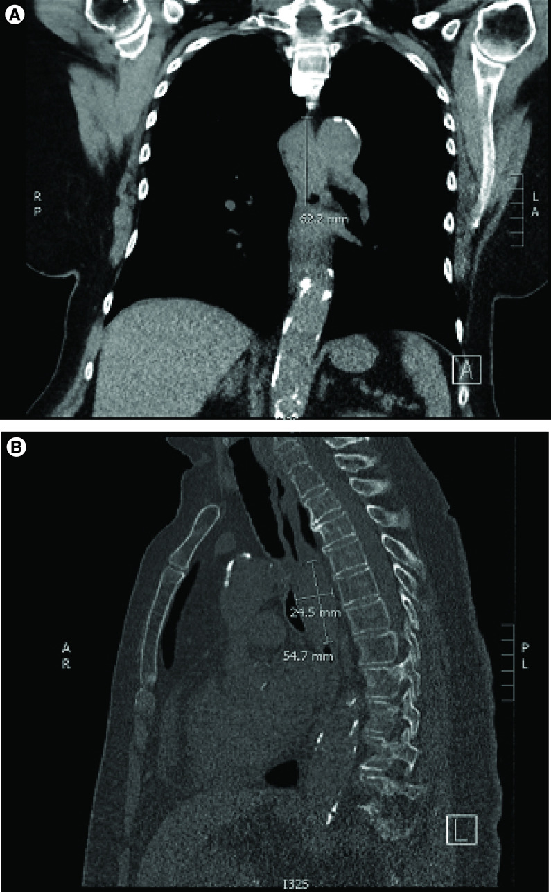 Primary esophageal melanoma: a case report.