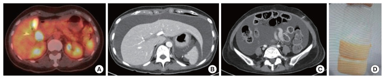 Alternative management of intractable chylous ascites following robot-assisted pancreaticoduodenectomy of Viscum album sclerotherapy: a case report.