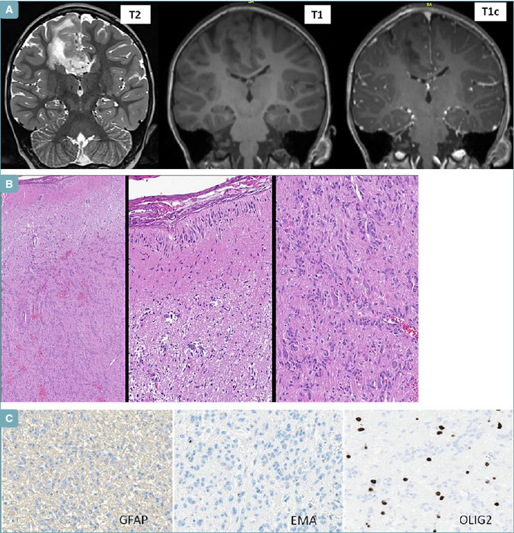 Paediatric-type diffuse low-grade gliomas: a clinically and biologically distinct group of tumours with a favourable outcome.