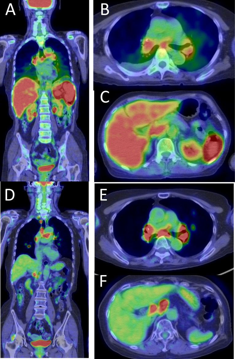 Diffuse large B-cell lymphoma in the course of systemic sarcoidosis: A case report and review of 30 Japanese patients with sarcoidosis-lymphoma syndrome.