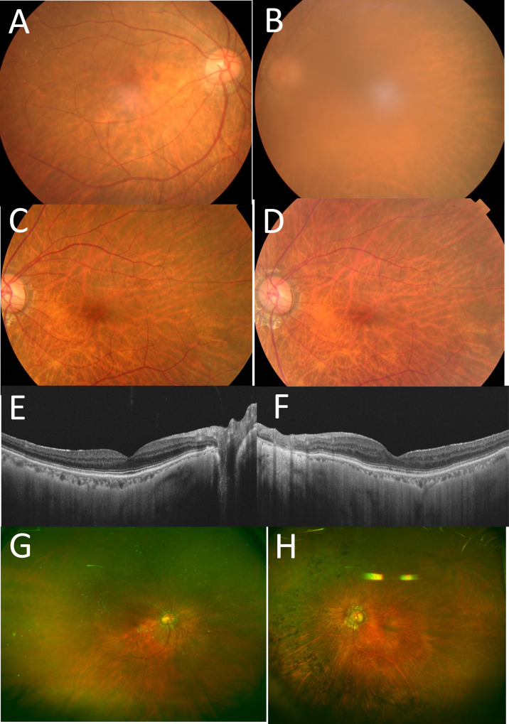 Diffuse large B-cell lymphoma in the course of systemic sarcoidosis: A case report and review of 30 Japanese patients with sarcoidosis-lymphoma syndrome.