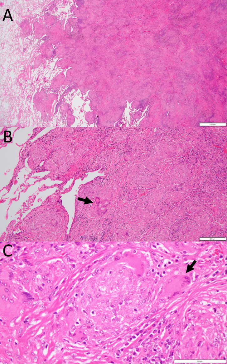 Diffuse large B-cell lymphoma in the course of systemic sarcoidosis: A case report and review of 30 Japanese patients with sarcoidosis-lymphoma syndrome.