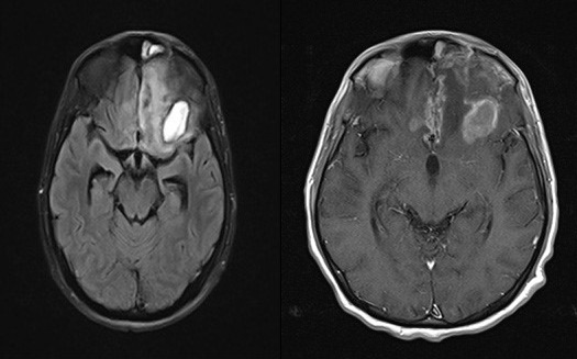 Brain Abscess Caused by <i>Nocardia asteroides</i> in a Diabetic Patient: A Rare Case Report.