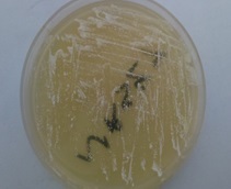 Brain Abscess Caused by <i>Nocardia asteroides</i> in a Diabetic Patient: A Rare Case Report.