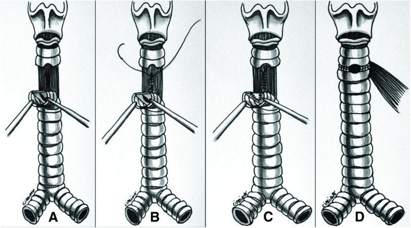 Acquired Benign Tracheoesophageal Fistula: An Alternative Tracheoplastic Technique.