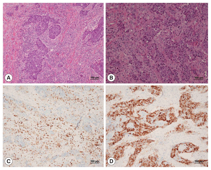 Ectopic cervical thymic squamous cell carcinoma misdiagnosed as thyroid cancer: a case report.