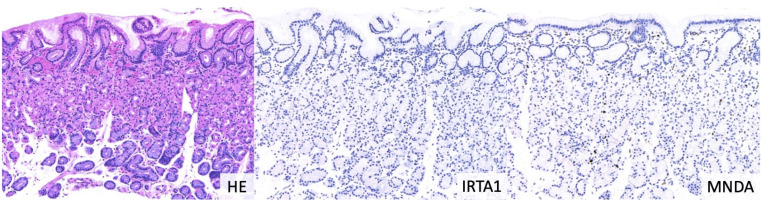 Immunohistochemistry for IRTA1 and MNDA helps differentiate gastric MALT lymphoma from chronic gastritis/reactive lymphocyte hyperplasia.