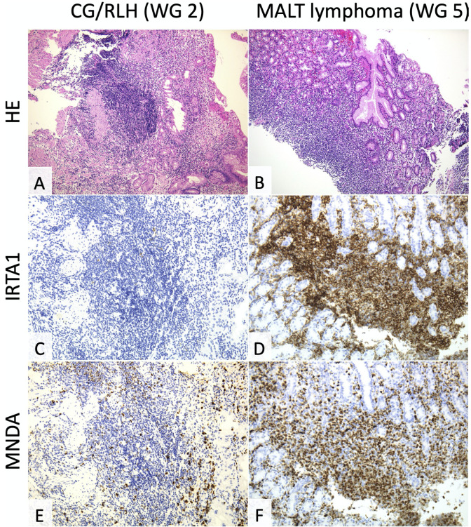 Immunohistochemistry for IRTA1 and MNDA helps differentiate gastric MALT lymphoma from chronic gastritis/reactive lymphocyte hyperplasia.