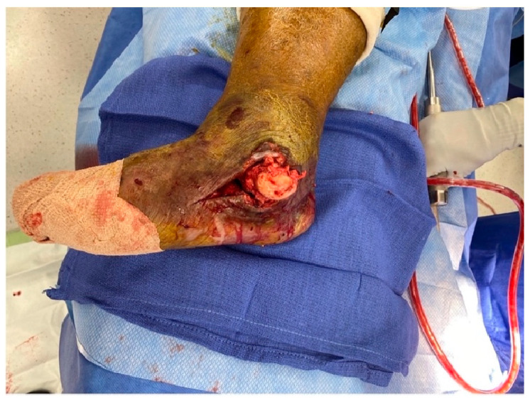 Salvage of Hindfoot Charcot with Osteomyelitis and Ulceration: A Case Report.