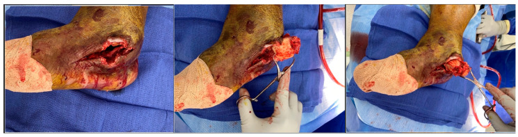 Salvage of Hindfoot Charcot with Osteomyelitis and Ulceration: A Case Report.