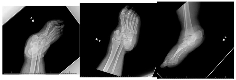 Salvage of Hindfoot Charcot with Osteomyelitis and Ulceration: A Case Report.