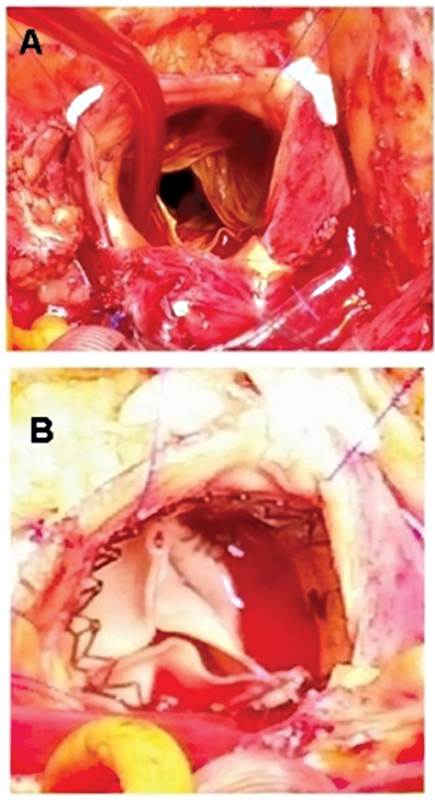 Replacement of a Calcified Aortic Valve in a Porcine Aortic Root with the Perceval Sutureless Bioprosthesis.