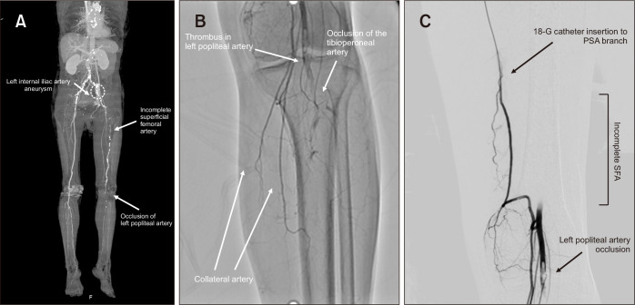 Catheter-Directed Thrombolysis for Persistent Sciatic Artery Presenting with Acute Limb Ischemia.